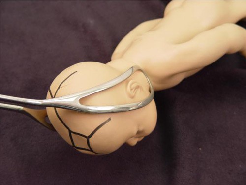 Nguyen nhan bat ngo khien thai nhi gay xuong trong bung me-Hinh-2
